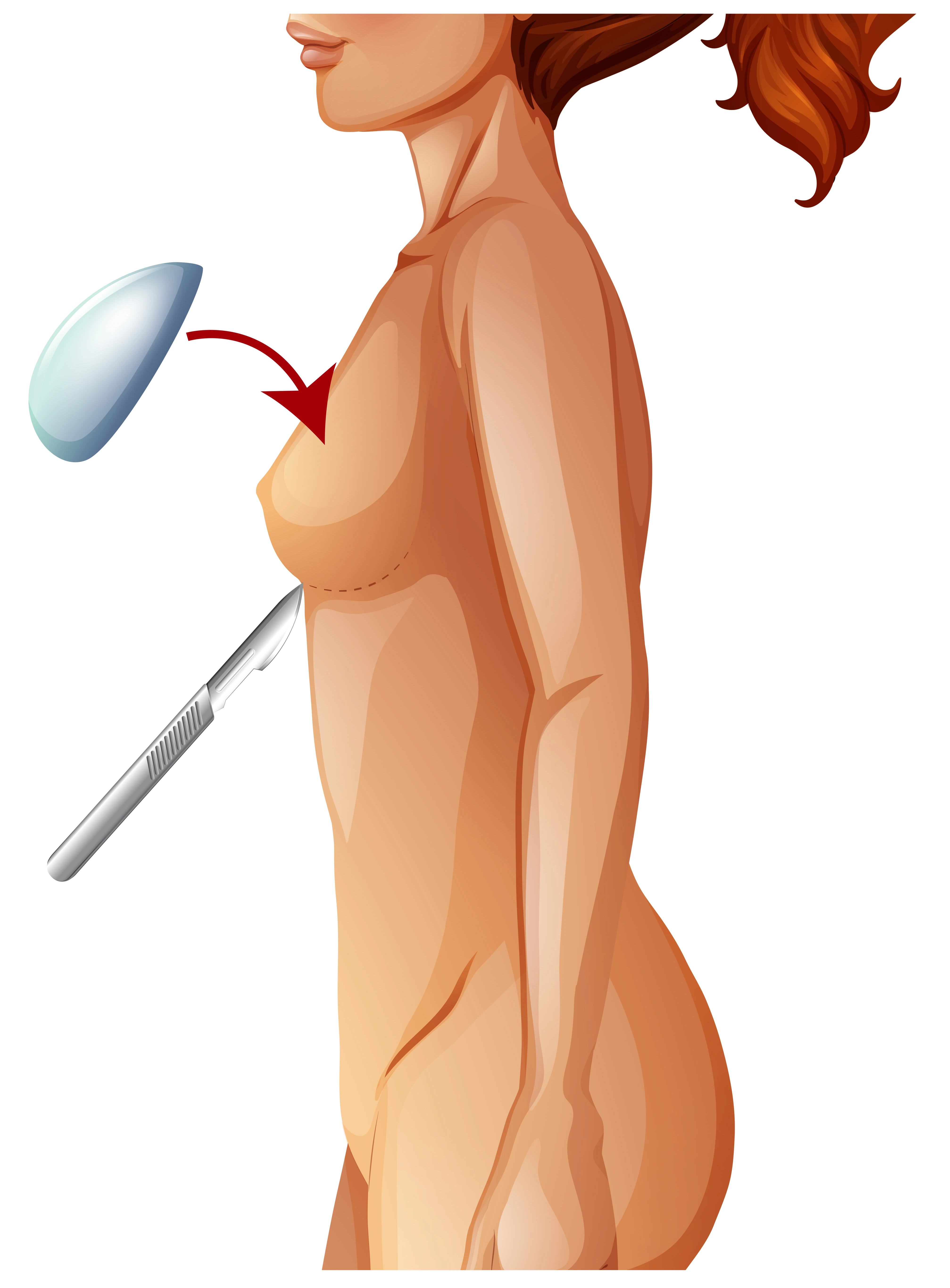 Breast Augmentation
