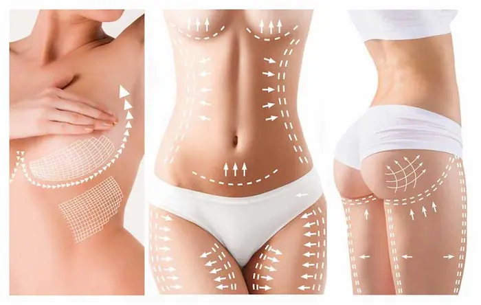Body Lift Procedures