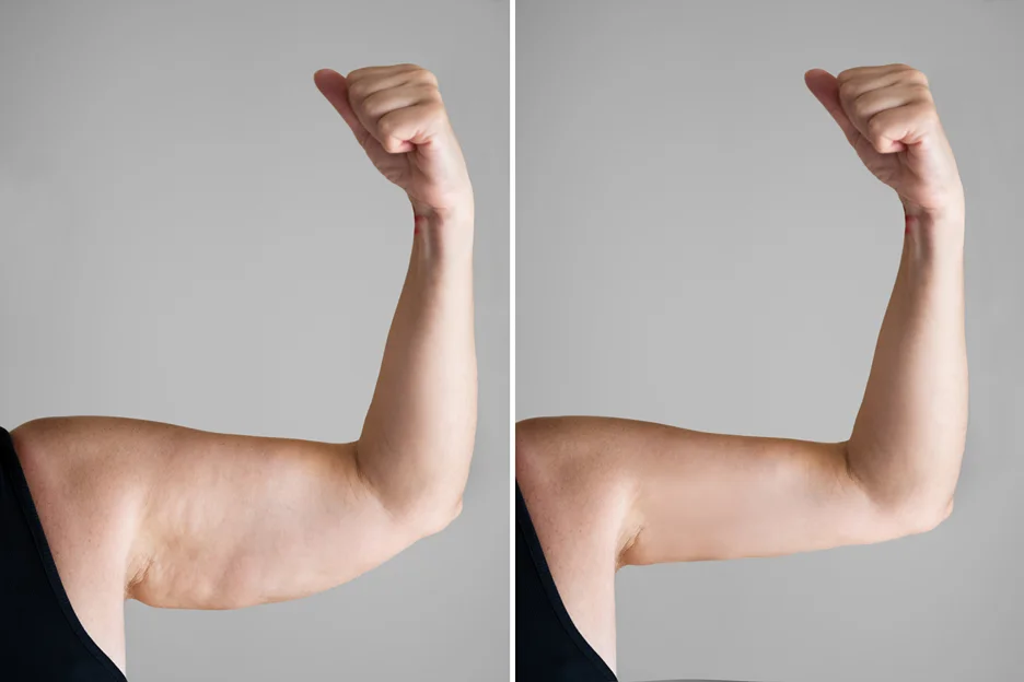 Arm Lift