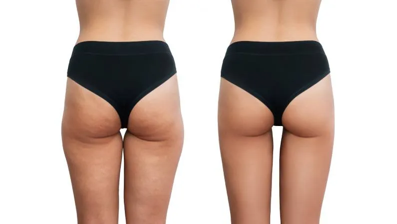 Thigh Lift