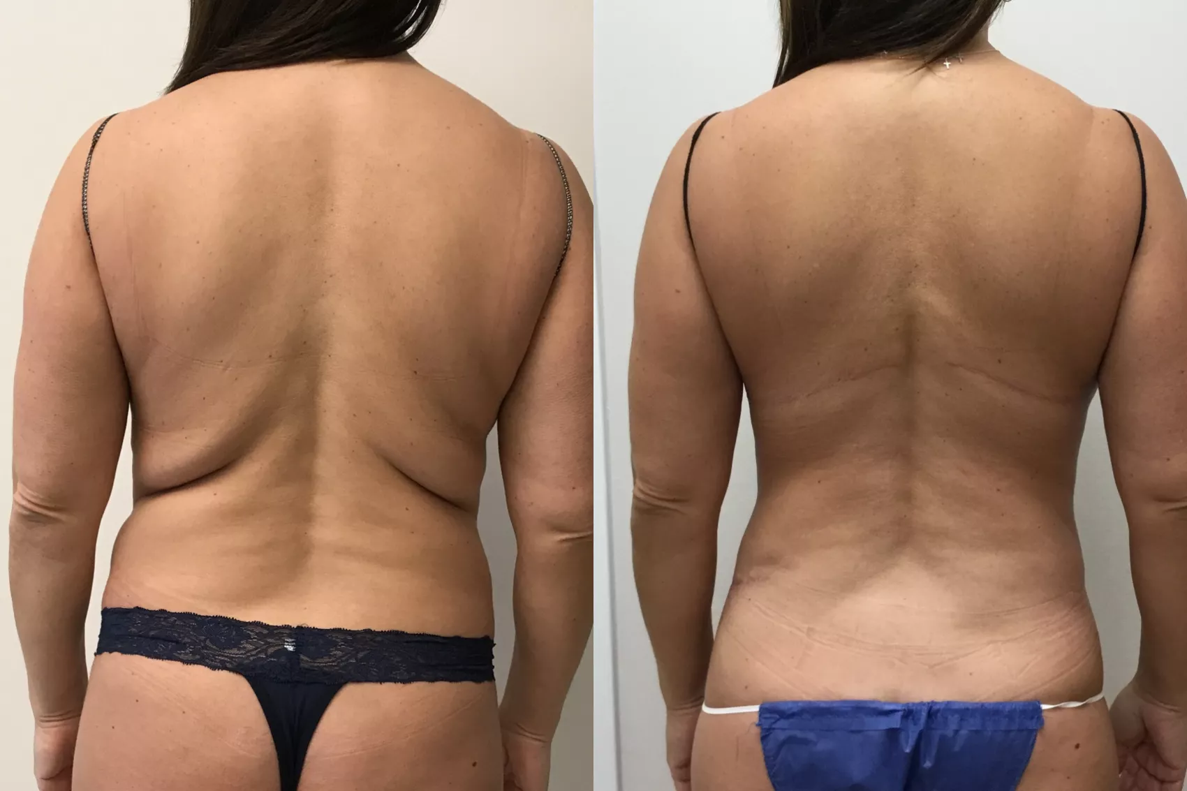 Upper Back Lift