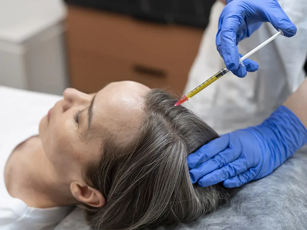 PRP for Scalp
