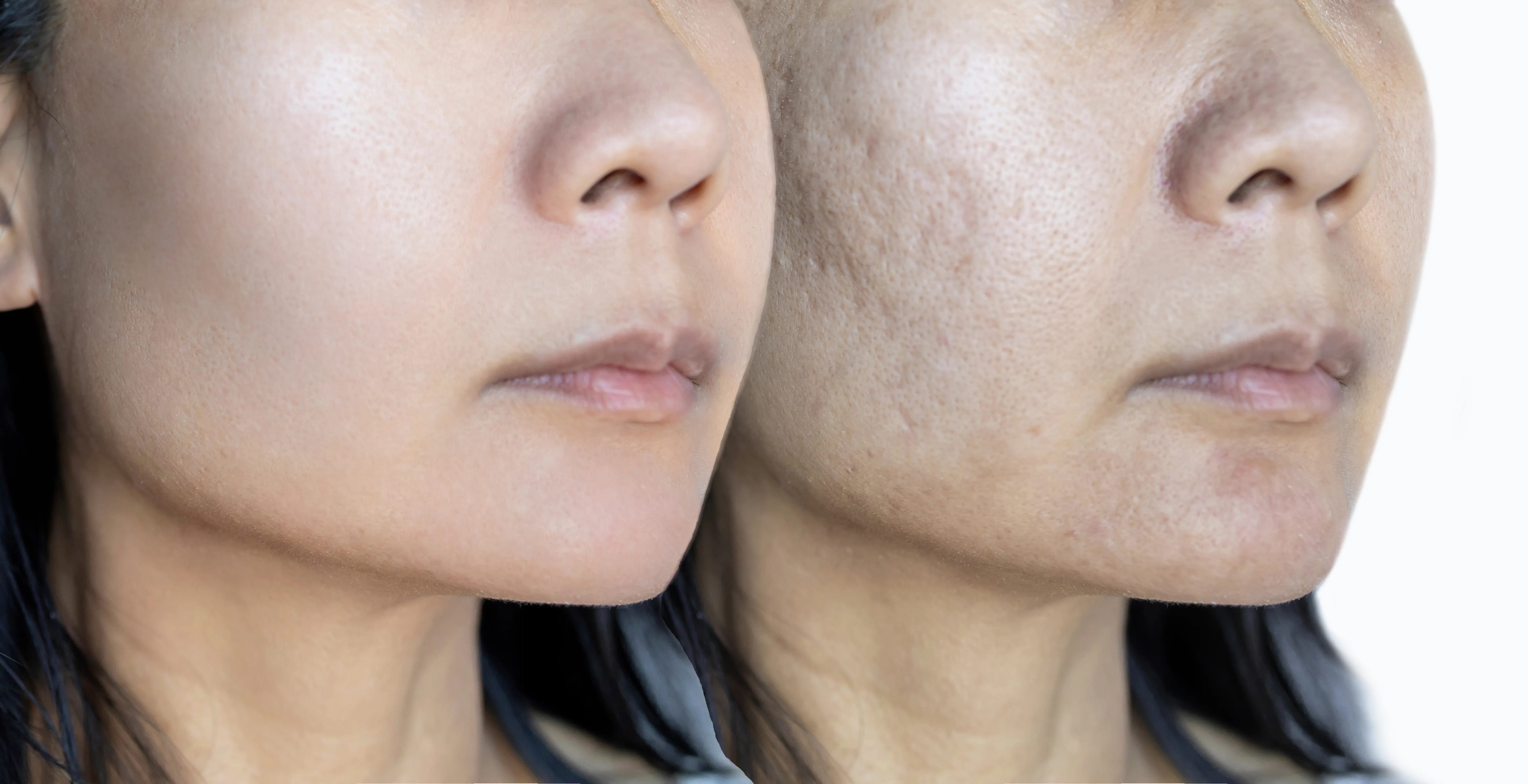 Large Pores Treatment