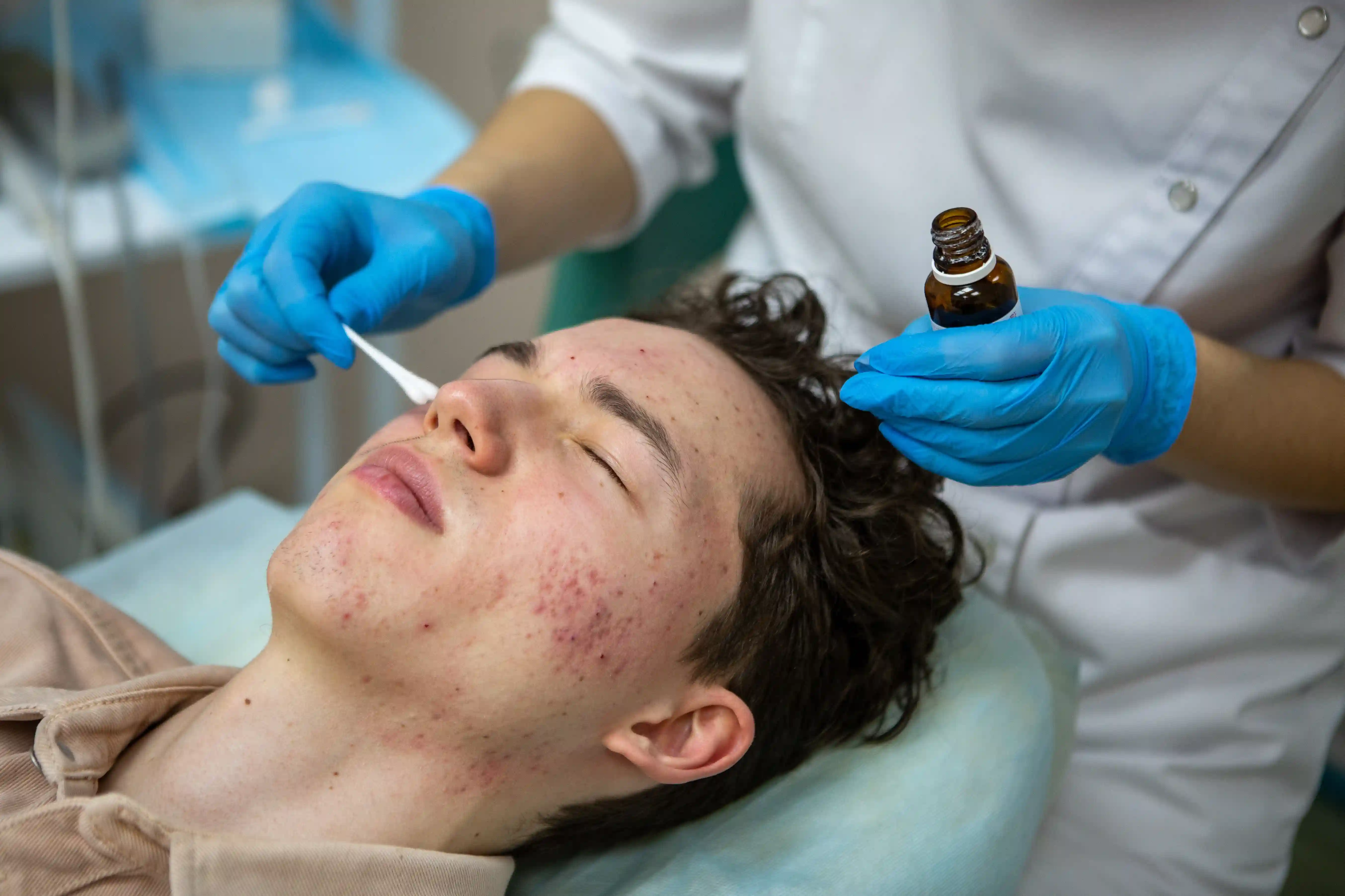 Acne Treatment
