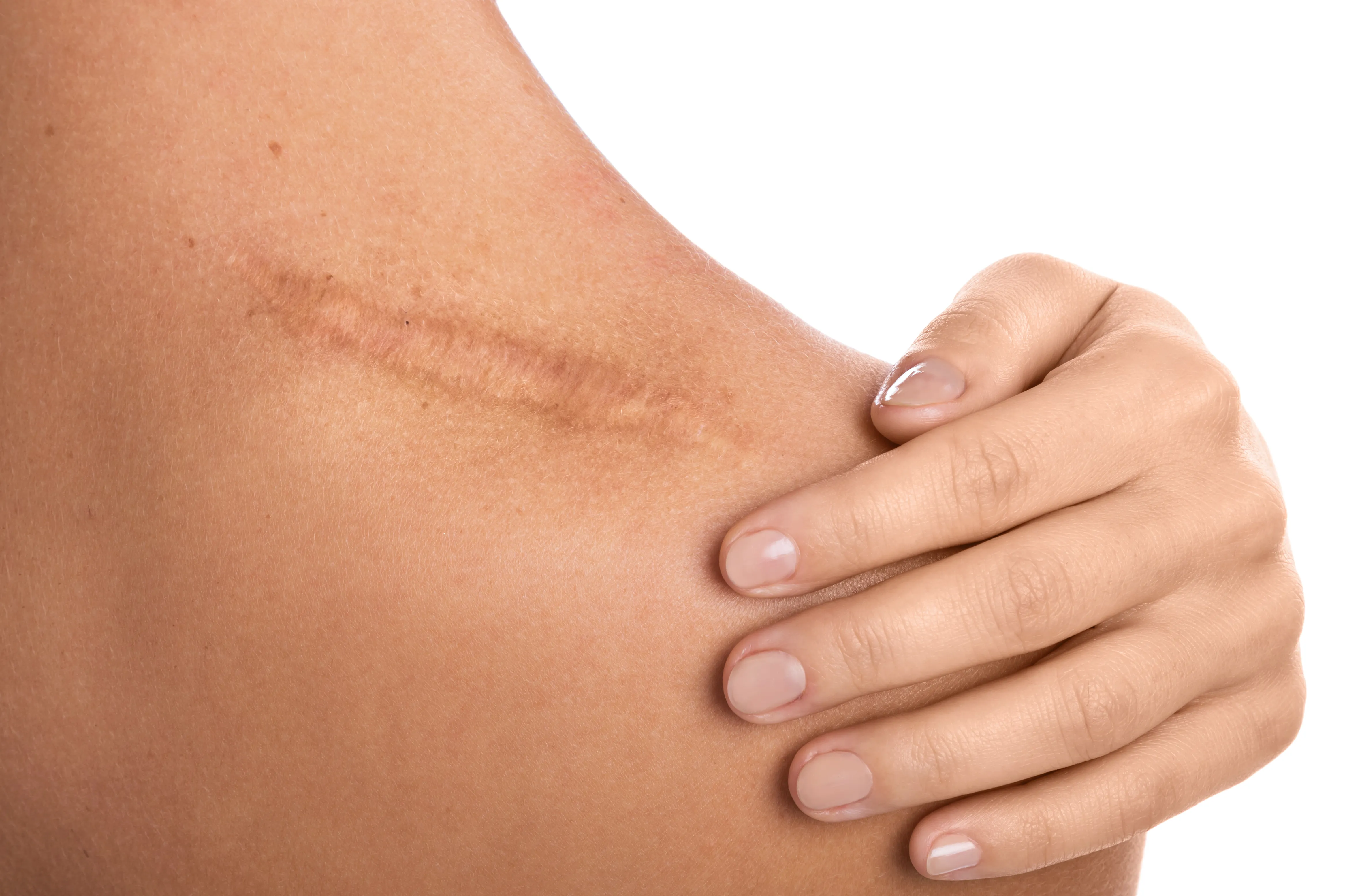Scar Treatment