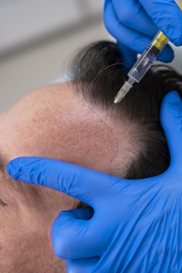 Stem Cell Hair Transplant