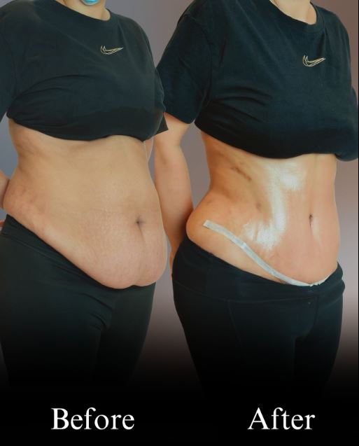 plastic surgery before after