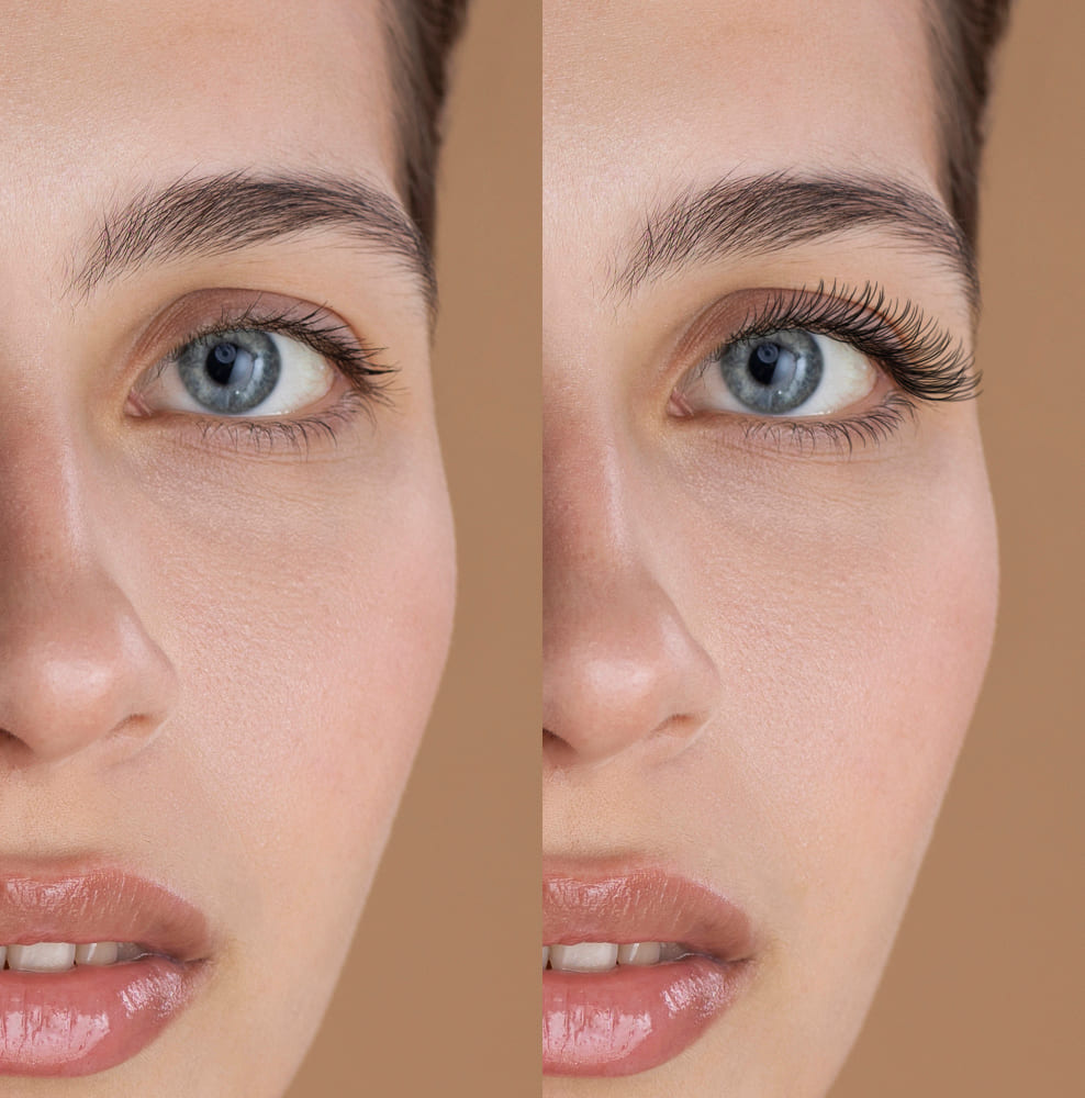 Blepharoplasty before after (1)