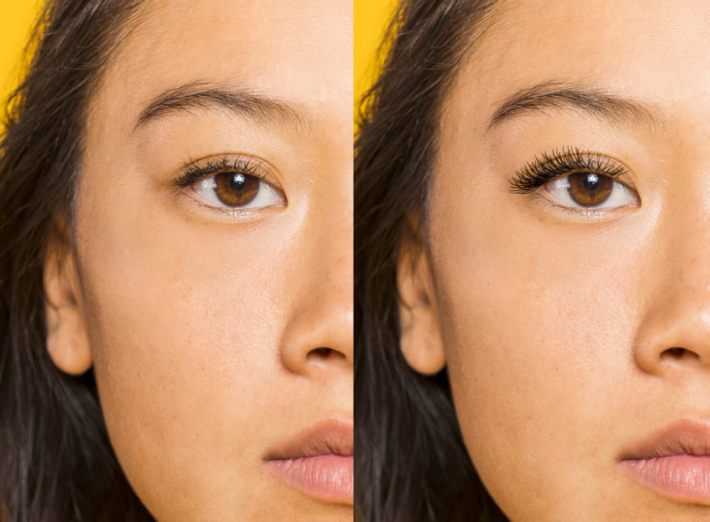 Blepharoplasty before after