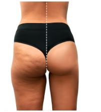 Buttock Augmentation before after 3