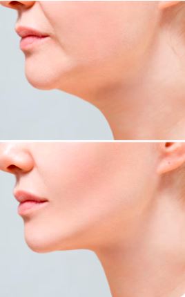 Chin Augmentation 2