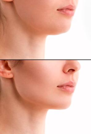 Chin Contouring with Dermal Fillers 2