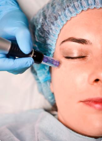 Dermapen Microneedling with Exosome Therapy 1