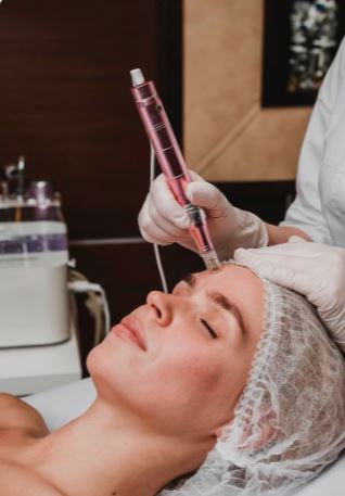 Dermapen Microneedling with Exosome Therapy 2