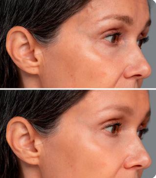 Dermapen Microneedling with Exosome Therapy before-after