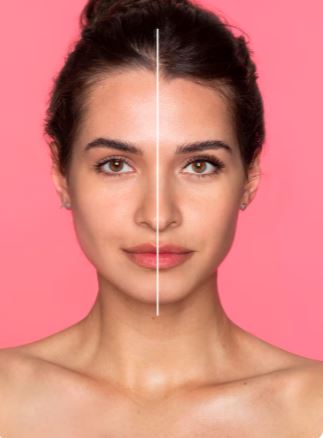 Facelift before-after 1