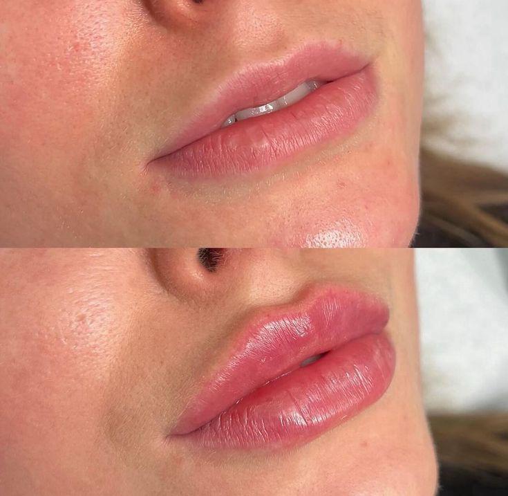 Lip Filler Treatments