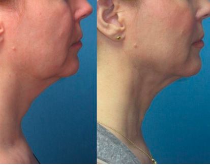 Lipochin treatment before adn after 3