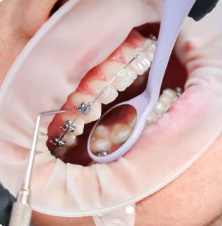 Orthodontic Treatment before-after