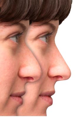 Rhinoplasty before-after