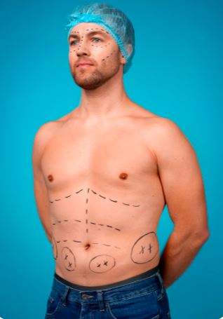 Trunkplasty (Beltlift)