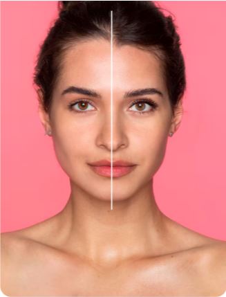 Ultherapy Skin Tightening Treatment 3