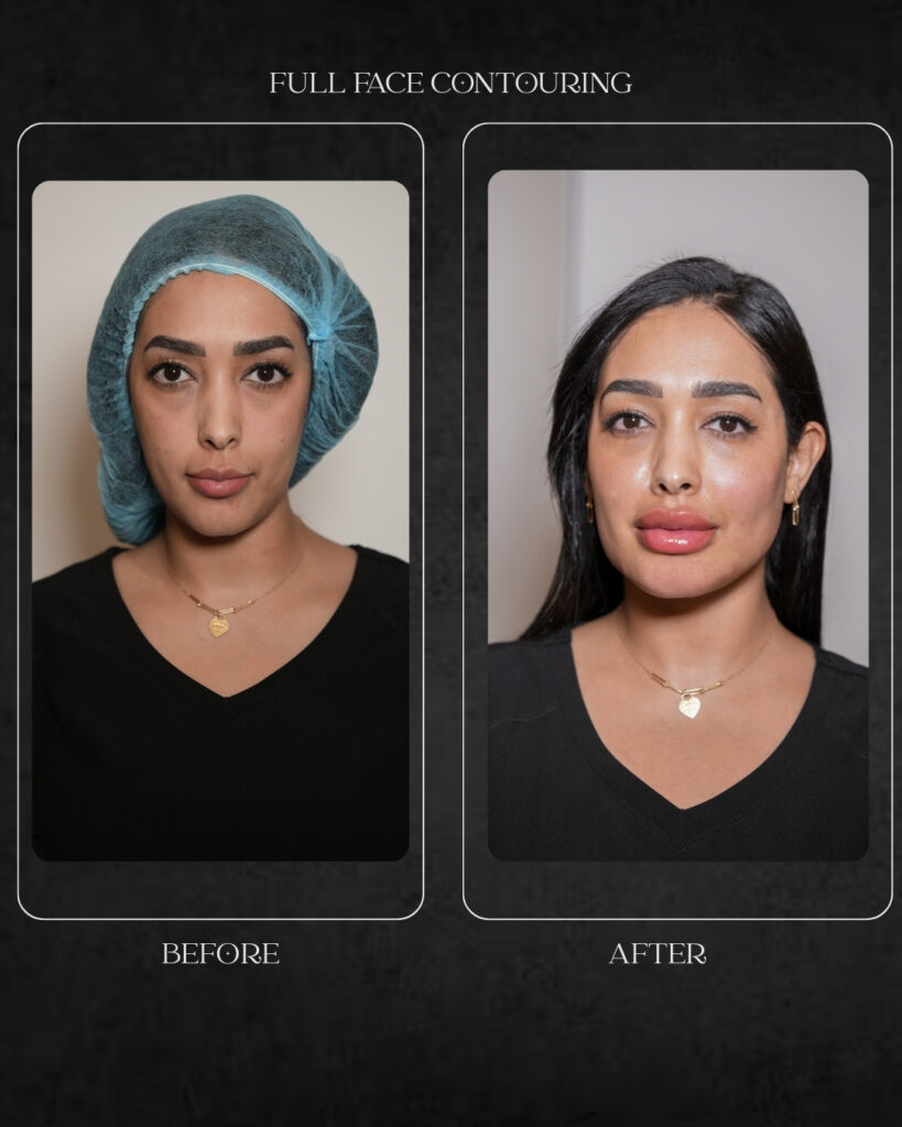 full face contouring