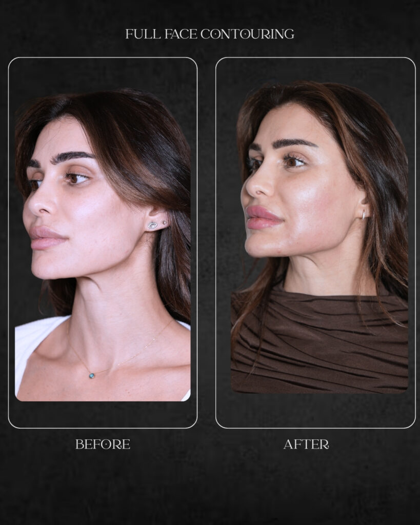 full face contouring