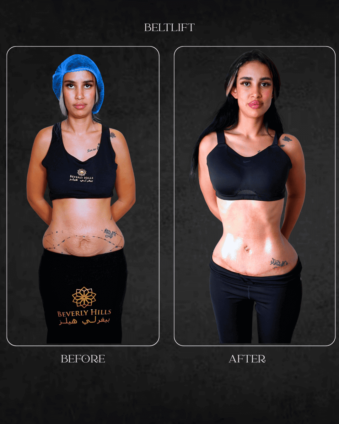 BELTLIFT Beverly Hills specialist Hospital Abu Dhabi