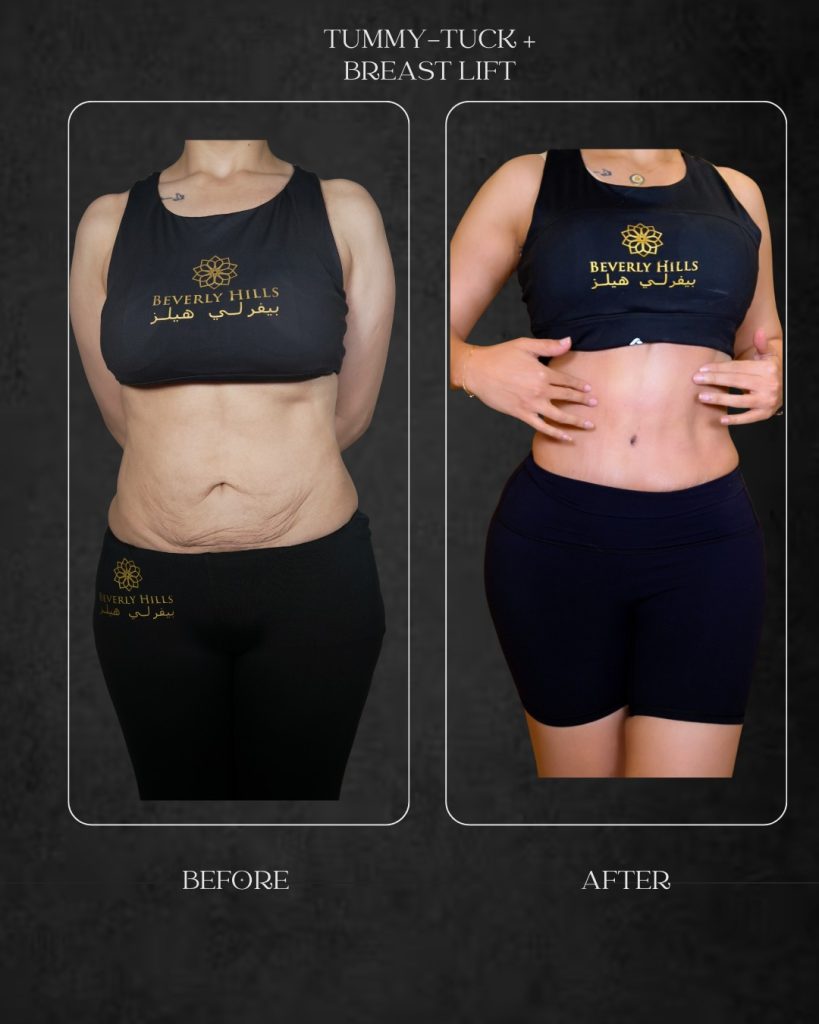 Tummy-Tuck-Dr-mariam