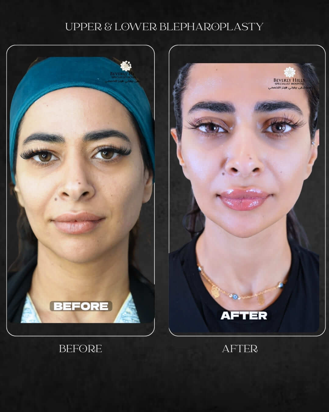 Upper lower Blepharoplasty Beverly Hills specialist Hospital Abu Dhabi