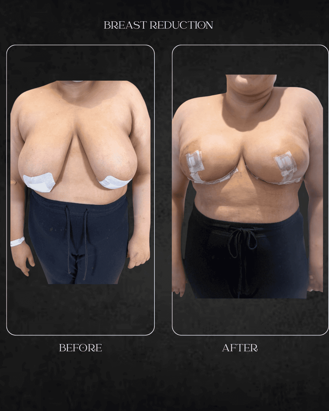 breast reduction Beverly Hills specialist Hospital Abu Dhabi