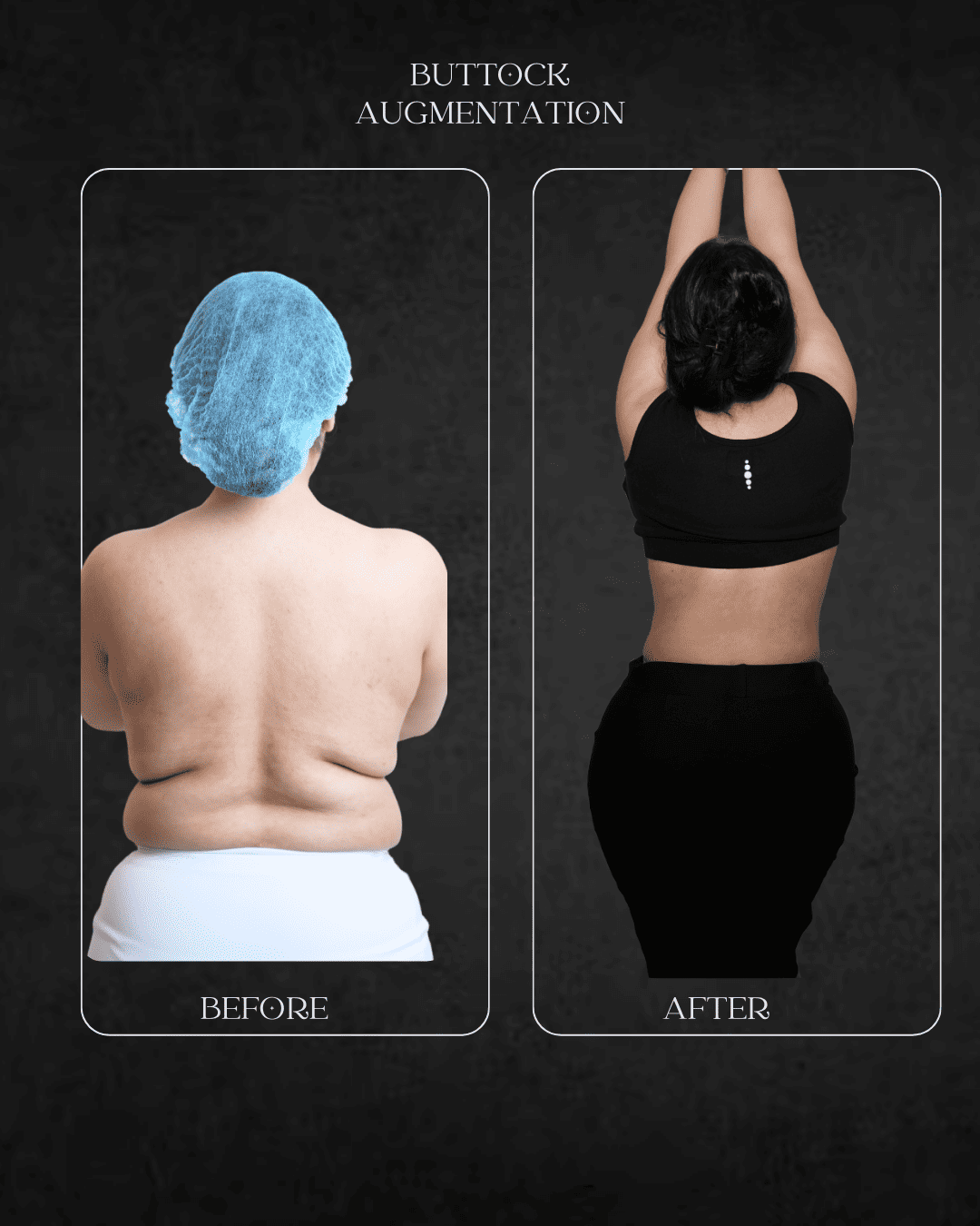 buttock augmentation Beverly Hills specialist Hospital Abu Dhabi