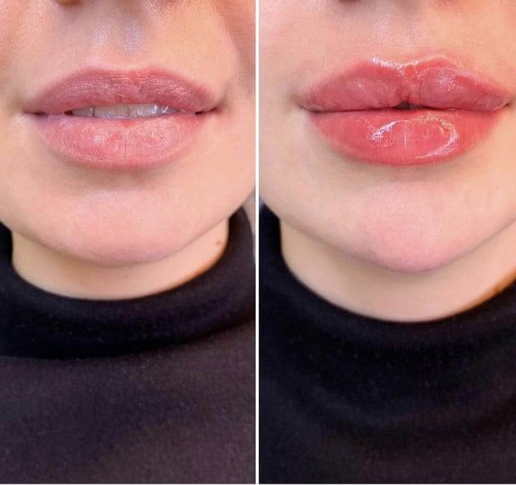 lip filler 2 Beverly Hills specialist Hospital Abu Dhabi