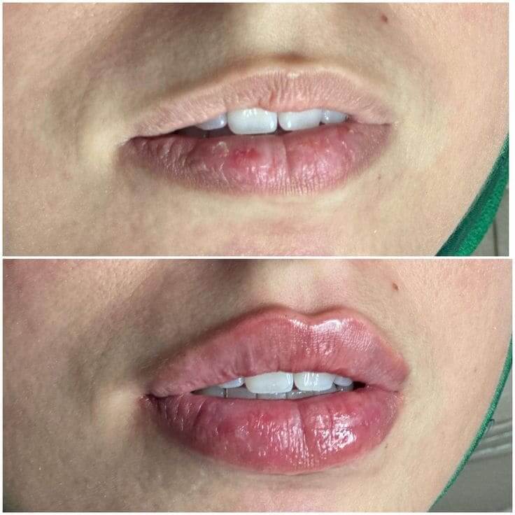 lip filler 3 Beverly Hills specialist Hospital Abu Dhabi