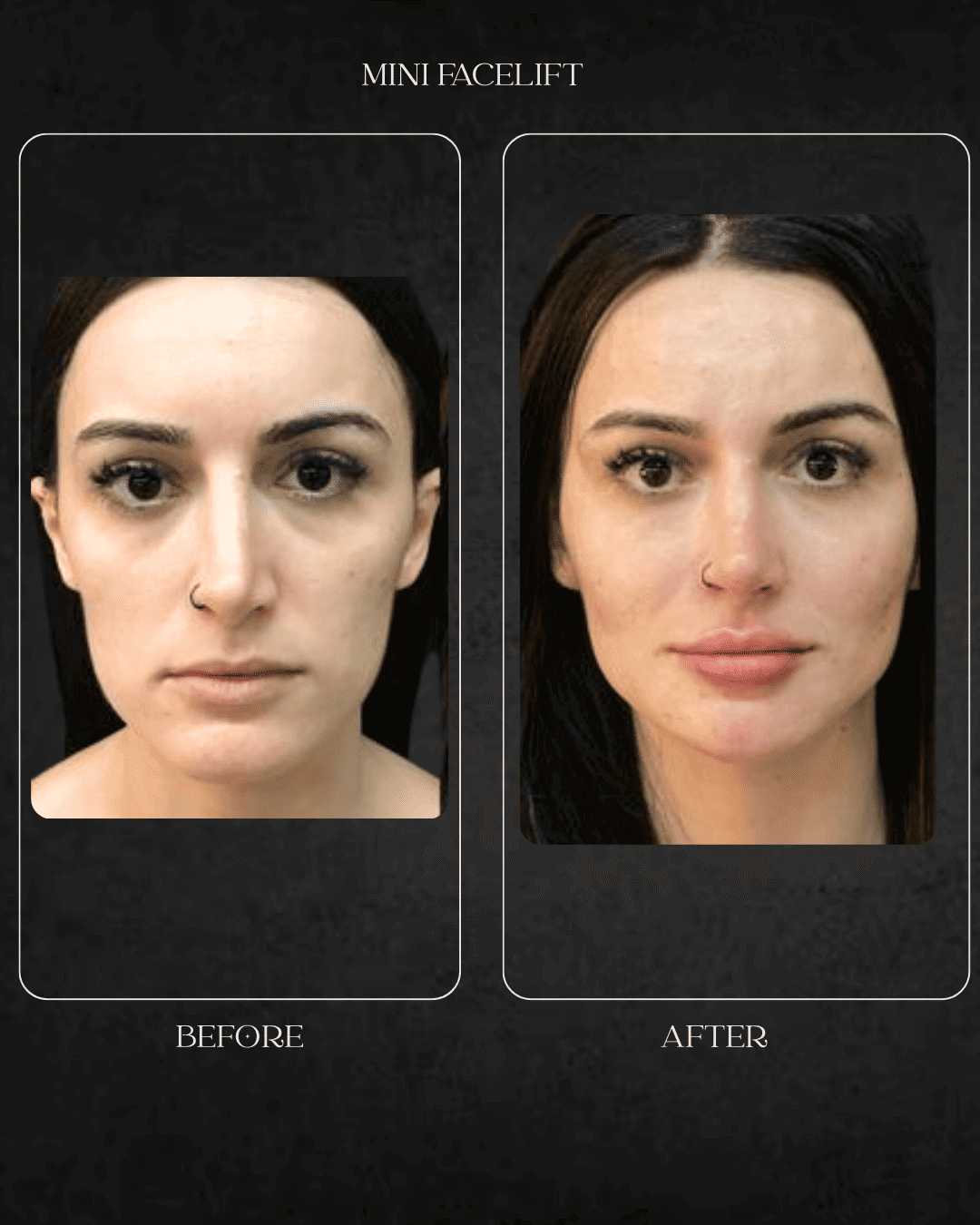 mini facelift 2 Beverly Hills specialist Hospital Abu Dhabi