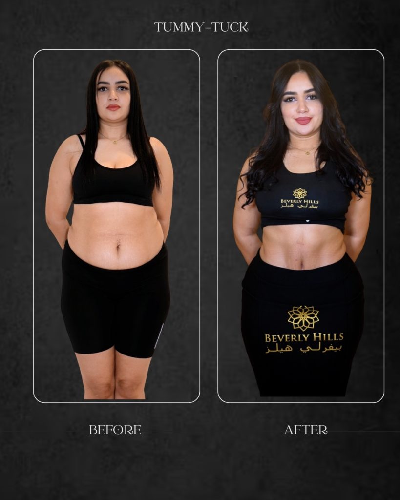 Dr Hamad Before After Results Tummy Tuck