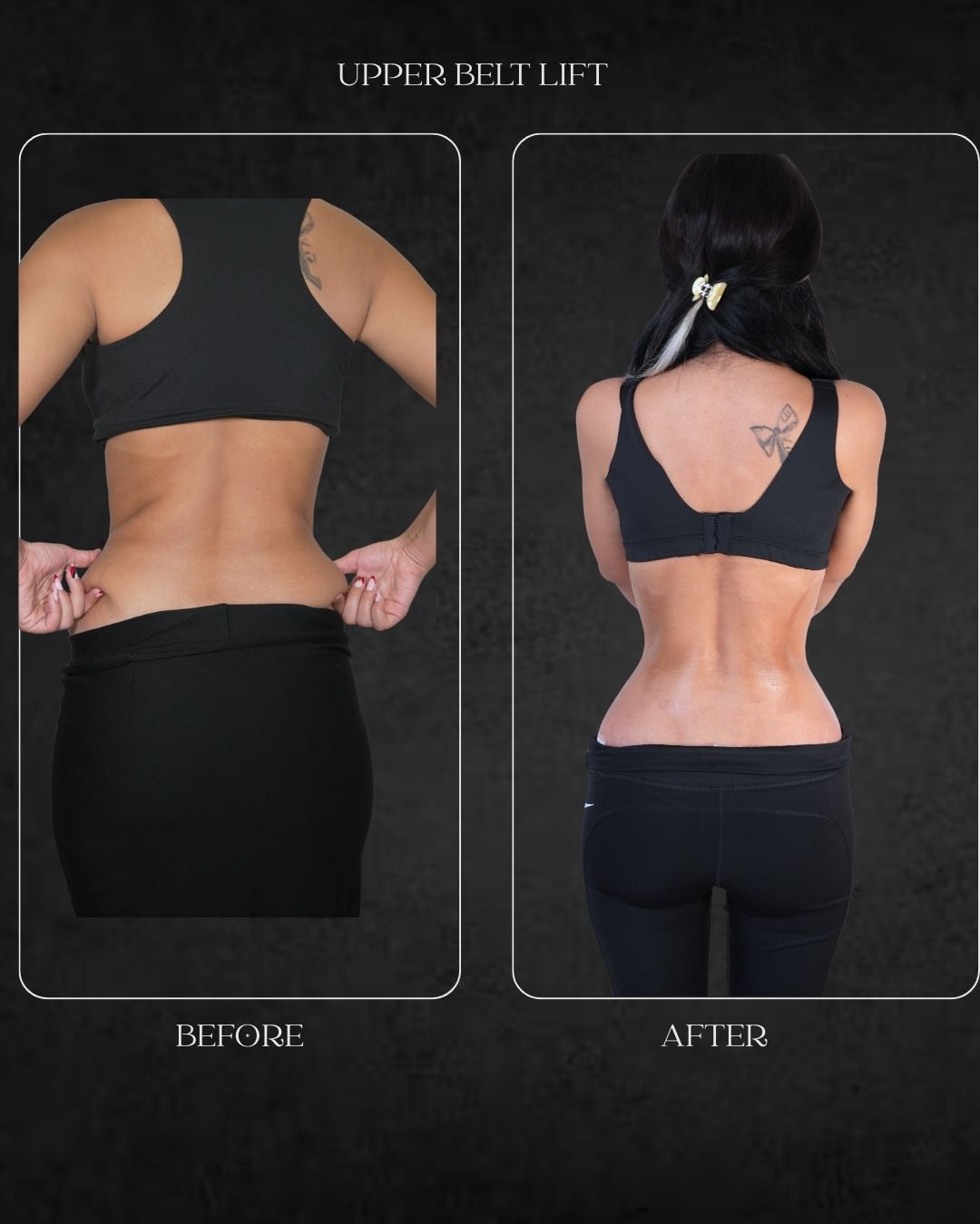 Upper Belt Lift ( Trunkplasty Surgery before after)